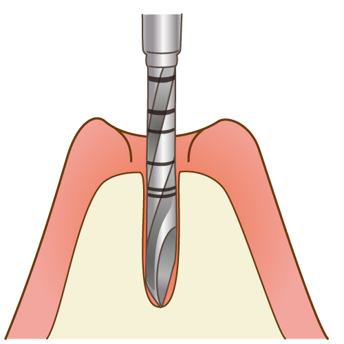 インプラント埋入手術